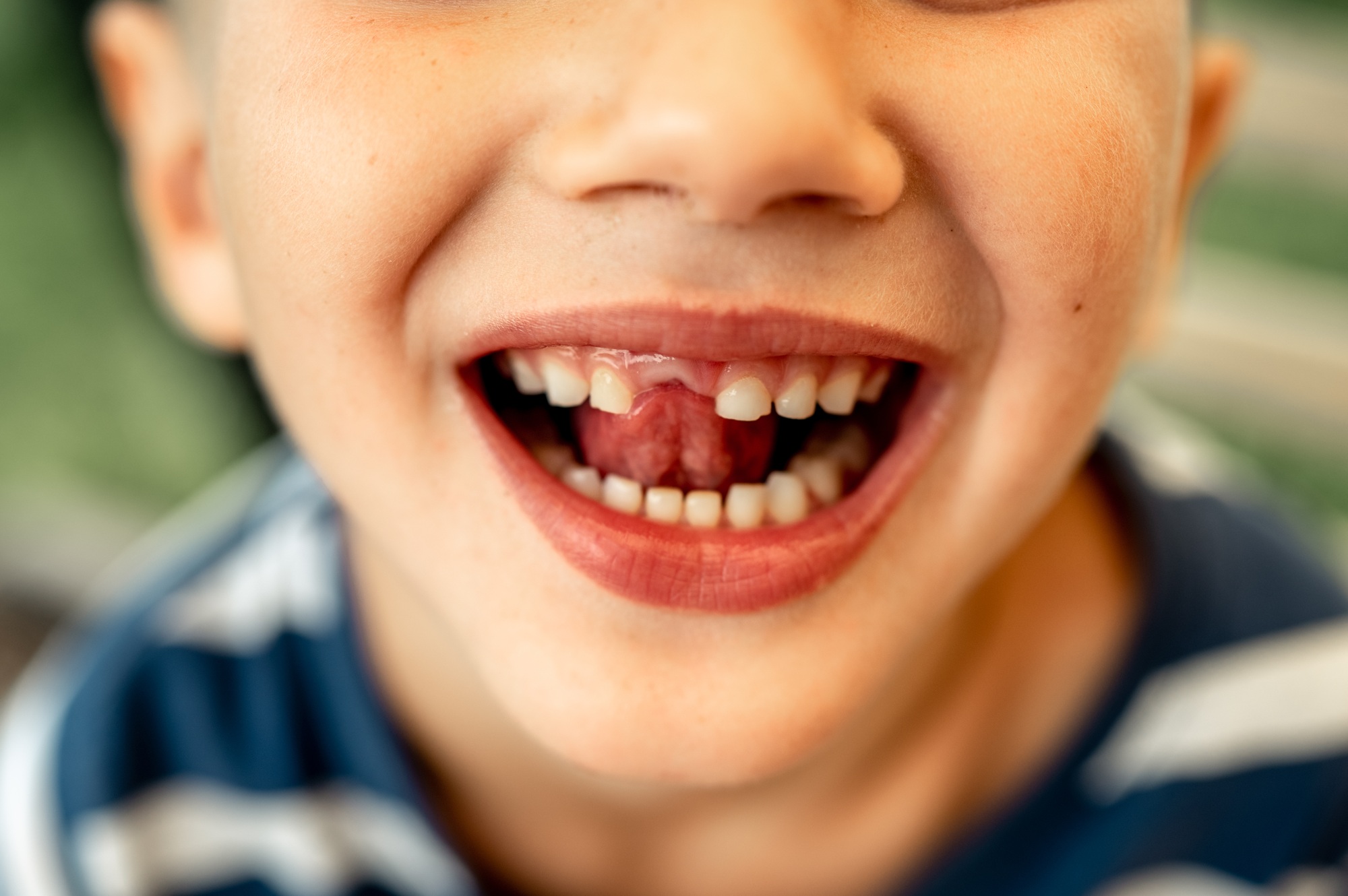 A five-year-old boy had his first milk tooth, a child's smile without one tooth